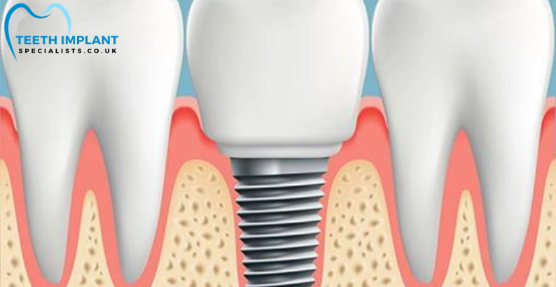 Dental Implants in UK