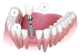 Dental implants Fall River