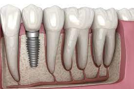 Dental implants Fall River
